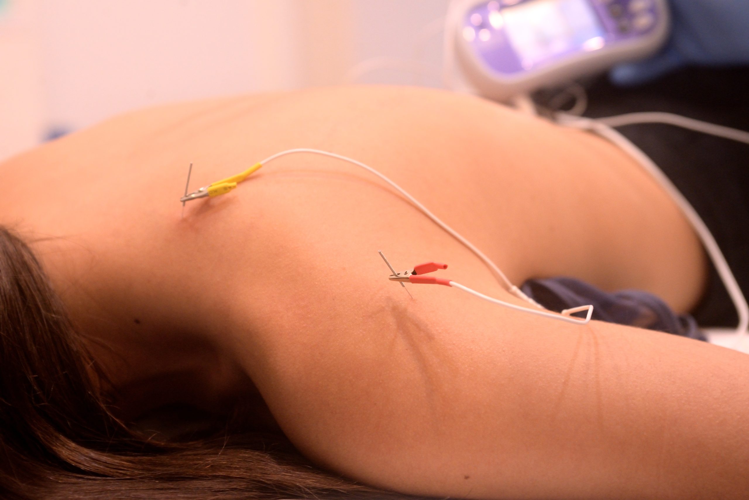 Punción seca y Electropunción - Momentum Vitae